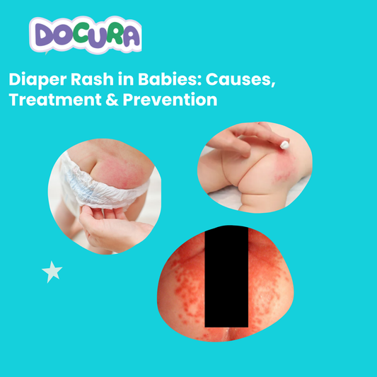 Diaper Rash in Babies: Causes, Treatment & Prevention