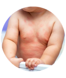 Baby Rashes